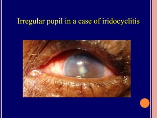 Irregular pupil in a case of iridocyclitis
 