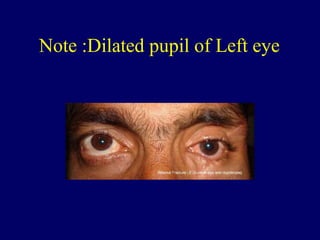 Note :Dilated pupil of Left eye
 