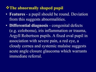 The abnormally shaped pupil
• Features - a pupil should be round. Deviation
from this suggests abnormalities.
• Differential diagnosis - congenital defects
(e.g. coloboma), iris inflammation or trauma,
Argyll Robertson pupils. A fixed oval pupil in
association with severe pain, a red eye, a
cloudy cornea and systemic malaise suggests
acute angle closure glaucoma which warrants
immediate referral.
 
