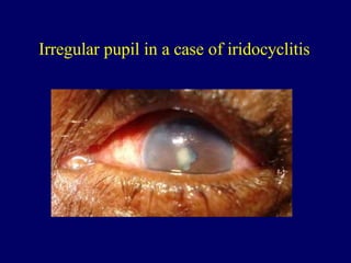 Irregular pupil in a case of iridocyclitis
 