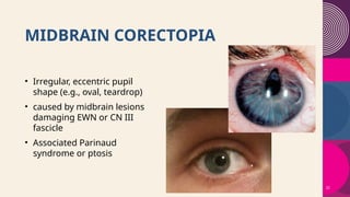 Pupil and Pupillary Abnormalities - Neuroanatomical Review.pptx