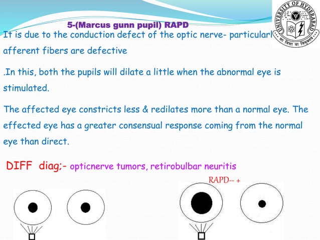 PUPIL DISORDERS PPT visual data 5