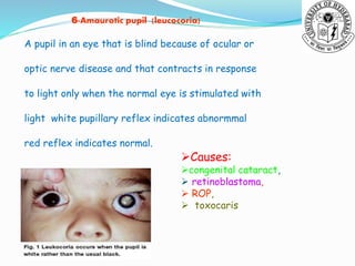 Pupil Mutations Pupil anomalies and disorders shiva ppt | PPTX