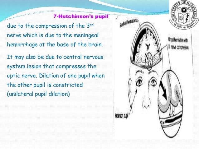 cn iii compression and fixed dilated pupil cn iii compression and fixed dilated pupil