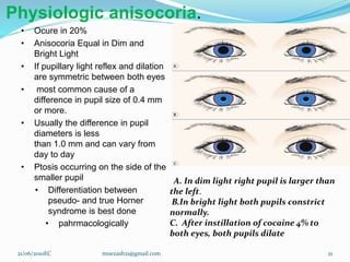 Physiologic anisocoria.
• Ocure in 20%
• Anisocoria Equal in Dim and
Bright Light
• If pupillary light reflex and dilation
are symmetric between both eyes
• most common cause of a
difference in pupil size of 0.4 mm
or more.
• Usually the difference in pupil
diameters is less
than 1.0 mm and can vary from
day to day
• Ptosis occurring on the side of the
smaller pupil
• Differentiation between
pseudo- and true Horner
syndrome is best done
• pahrmacologically
21/06/2010EC muezash21@gmail.com 21
A. In dim light right pupil is larger than
the left.
B.In bright light both pupils constrict
normally.
C. After instillation of cocaine 4% to
both eyes, both pupils dilate
 