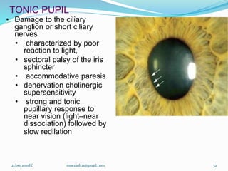 TONIC PUPIL
• Damage to the ciliary
ganglion or short ciliary
nerves
• characterized by poor
reaction to light,
• sectoral palsy of the iris
sphincter
• accommodative paresis
• denervation cholinergic
supersensitivity
• strong and tonic
pupillary response to
near vision (light–near
dissociation) followed by
slow redilation
21/06/2010EC muezash21@gmail.com 32
 
