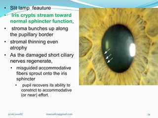• Slit lamp feauture
• Iris crypts stream toward
normal sphincter function,
• stroma bunches up along
the pupillary border
• stromal thinning even
atrophy
• As the damaged short ciliary
nerves regenerate,
• misguided accommodative
fibers sprout onto the iris
sphincter
• pupil recovers its ability to
constrict to accommodative
(or near) effort.
21/06/2010EC muezash21@gmail.com 34
 