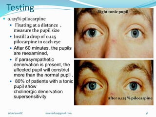 Testing
 0.125% pilocarpine
 Fixating at a distance ,
measure the pupil size
 Instill a drop of 0.125
pilocarpine in each eye
 After 60 minutes, the pupils
are reexamined,
 if parasympathetic
denervation is present, the
affected pupil will constrict
more than the normal pupil .
 80% of patients with a tonic
pupil show
cholinergic denervation
supersensitivity
21/06/2010EC muezash21@gmail.com 36
Right tonic pupil
After 0.125 % pilocarpine
 