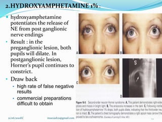 2.HYDROXYAMPHETAMINE 1% :
 hydroxyamphetamine
potentiates the release of
NE from post ganglionic
nerve endings
• Result : in the
preganglionic lesion, both
pupils will dilate. In
postganglionic lesion,
Horner’s pupil continues to
constrict.
• Draw back
• high rate of false negative
results
• commercial preparations
difficult to obtain
21/06/2010EC muezash21@gmail.com 49
 