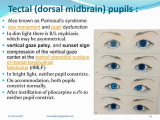 Tectal (dorsal midbrain) pupils :
 Also known as Parinaud's syndrome
 eye movement and pupil dysfunction
 In dim light there is B/L mydriasis
which may be asymmetrical.
 vertical gaze palsy, and sunset sign
 compression of the vertical gaze
center at the rostral interstitial nucleus
of medial longitudinal
fasciculus (riMLF)
 In bright light, neither pupil constricts.
 On accommodation, both pupils
constrict normally.
 After instillation of pilocarpine 0.1% to
neither pupil constrict.
50
21/06/2010EC muezash21@gmail.com
 