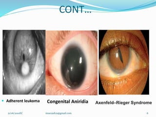 CONT…
 Adherent leukoma
6
Congenital Aniridia Axenfeld–Rieger Syndrome
21/06/2010EC muezash21@gmail.com
 