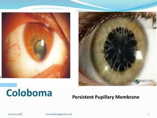7
Coloboma Persistent Pupillary Membrane
21/06/2010EC muezash21@gmail.com
 