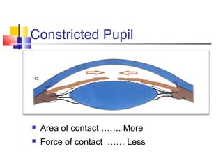 Constricted Pupil 
 Area of contact ……. More 
 Force of contact …… Less 
 