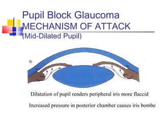 Pupil Block Glaucoma 
MECHANISM OF ATTACK 
(Mid-Dilated Pupil) 
Dilatation of pupil renders peripheral iris more flaccid 
Increased pressure in posterior chamber causes iris bombe 
 