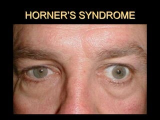HORNER’S SYNDROME
 