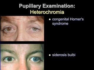 Pupillary Examination:
Heterochromia
 congenital Horner's
syndrome
 siderosis bulbi
 