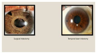 Surgical iridectomy Temporal laser iridotomy
 