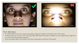 Tip 5: Dark Irises
• It is often difficult to view a consensual pupillary response in patients with dark irises in dark rooms.
• In these cases, you can use a dim secondary light held below the pupils in addition to your bright primary light that
you use to elicit the pupillary response.
• If your secondary light is too bright it will cause undesirable constriction of the pupil.
 