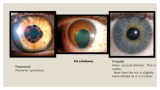 Festooned
Posterior synechiae.
Irregular
Adies sectoral dilation. This is
subtle.
Note how the iris is slightly
more dilated at 2-3 o’clock.
Iris coloboma
 