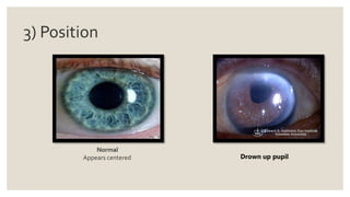 3) Position
Normal
Appears centered Drown up pupil
 