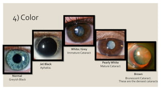 4) Color
Normal
Greyish Black
Jet Black
Aphakia.
White / Grey
Immature Cataract
Pearly White
Mature Cataract
Brown
Brunescent Cataract.
These are the densest cataracts
 