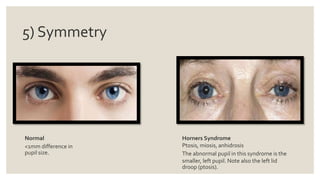 5) Symmetry
Normal
<1mm difference in
pupil size.
Horners Syndrome
Ptosis, miosis, anhidrosis
The abnormal pupil in this syndrome is the
smaller, left pupil. Note also the left lid
droop (ptosis).
 