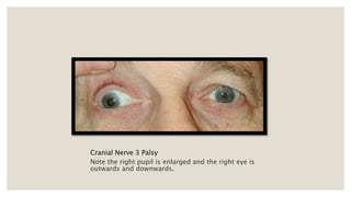 Cranial Nerve 3 Palsy
Note the right pupil is enlarged and the right eye is
outwards and downwards.
 