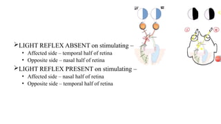 Light Reflex Present Types of pupillary abnormalities in Ophthalmology.pptx