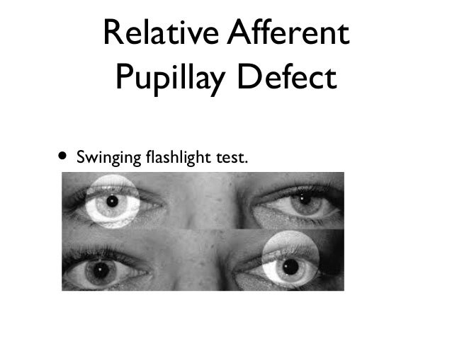 a reduction in anxiety pupil constriction a reduction in anxiety pupil constriction