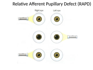 PUPILLARY EXAMINATION.pptx pupillary exam | PPTX
