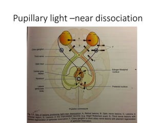Pupillary light –near dissociation
 