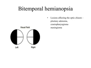 Bitemporal hemianopsia
• Lesions affecting the optic chiasm –
pituitary adenoma,
craniopharyngioma
meningioma
 