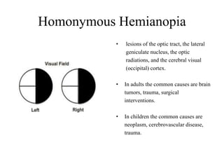 Homonymous Hemianopia
• lesions of the optic tract, the lateral
geniculate nucleus, the optic
radiations, and the cerebral visual
(occipital) cortex.
• In adults the common causes are brain
tumors, trauma, surgical
interventions.
• In children the common causes are
neoplasm, cerebrovascular disease,
trauma.
 