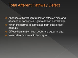  Absence of Direct light reflex on affected side and
absence of consensual light reflex on normal side
 When the normal is stimulated both pupils react
normally
 Diffuse illumination both pupils are equal in size
 Near reflex is normal in both eyes
 