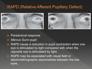  Paradoxical response
 Marcus Gunn pupil
 RAPD cause a reduction in pupil contraction when one
eye is stimulated by light compared with when the
opposite eye is stimulated by light.
 RAPD may be associated with visual field or
electroretinographic asymmetries between the two
eyes.
 