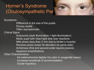 Symptoms:
Difference in the size of the pupils
Droopy eyelid
Often asymptomatic
Critical Signs:
Anisocoria (dark illumination > light illumination)
Miotic pupil with intact light and near reactions
Mild ptosis (less than 2 mm due to Muller’s muscle)
. Reverse ptosis (lower lid elevation on same side)
Anhidrosis (first and second-order neuron) lesions
Apparent enophthalmos
Other Characteristics:
Iris heterochromia (lighter iris color in congenital cases)
Increased amplitude of accommodation
Ocular hypotony
 