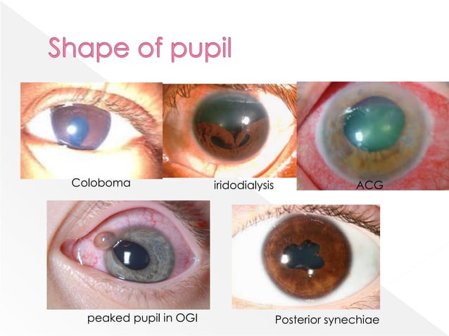 Pupil Mutations importance Of Pupil Examination | PDF