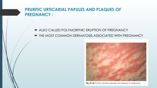 Pup Rash puppp in dermatology and obstetrics.pptx
