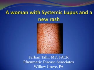 Farhan Tahir MD, FACR
Rheumatic Disease Associates
     Willow Grove, PA
 