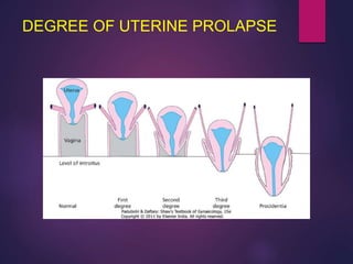 DEGREE OF UTERINE PROLAPSE
 