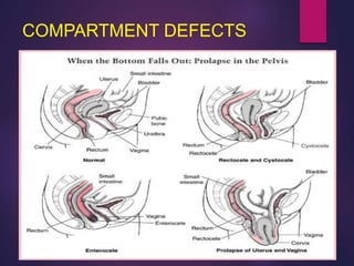 COMPARTMENT DEFECTS
 