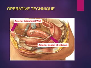Anterior Abdominal Wall
Anterior aspect of isthmus
OPERATIVE TECHNIQUE
 