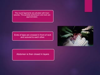 The round ligaments are plicated with linen
sutures. The parietal peritoneum and recti are
approximated.
Ends of tape are crossed in front of recti
and sutured to each other.
Abdomen is then closed in layers
 