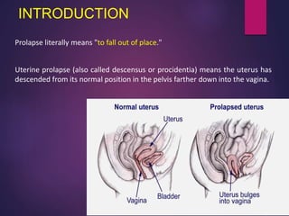 INTRODUCTION
Prolapse literally means "to fall out of place."
Uterine prolapse (also called descensus or procidentia) means the uterus has
descended from its normal position in the pelvis farther down into the vagina.
 