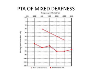 Pta Graph Pure tone audiometry | PPTX