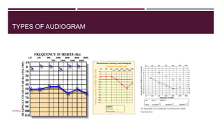 TYPES OF AUDIOGRAM

DRTBALU'S OTOLARYNGOLOGY ONLINE

 
