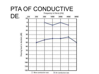 PTA OF CONDUCTIVE
DEAFNESS
 