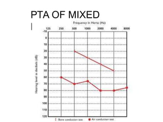 PTA OF MIXED
DEAFNESS
 
