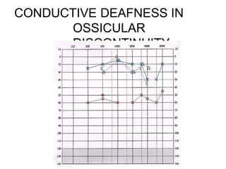 CONDUCTIVE DEAFNESS IN
OSSICULAR
DISCONTINUITY
 