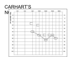 CARHART’S
NOTCH(OTOSCLEROSIS)
 